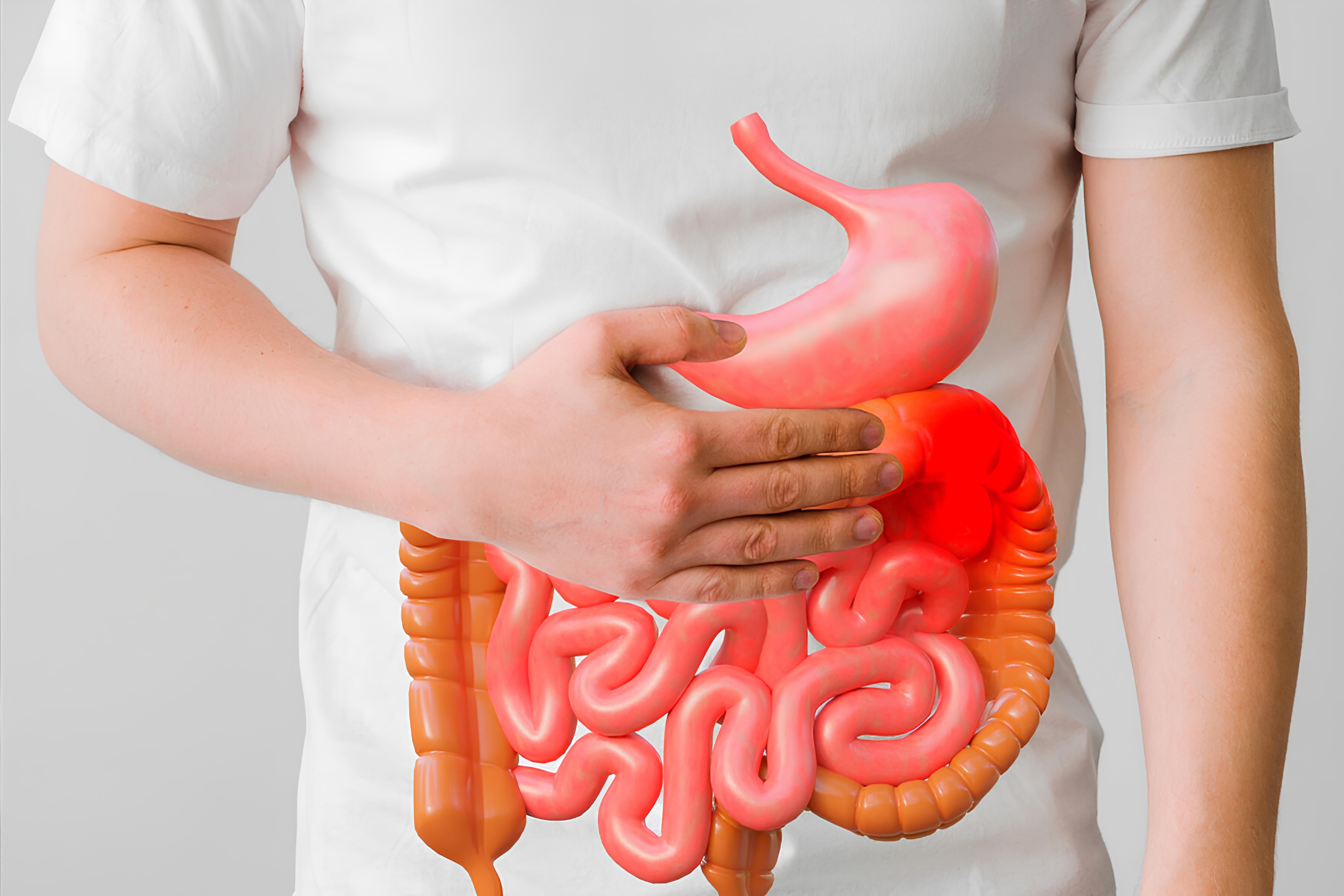 Crohn Hastalığı