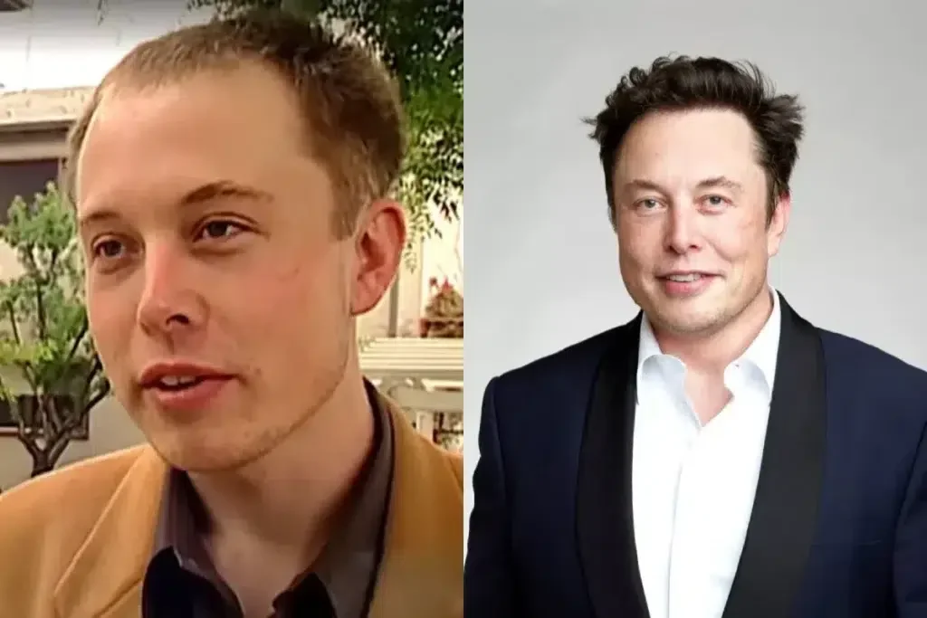 Elon Musk Hair Transplant Claims: Hair Replacement, Implants, and the Truth About Hair Plugs