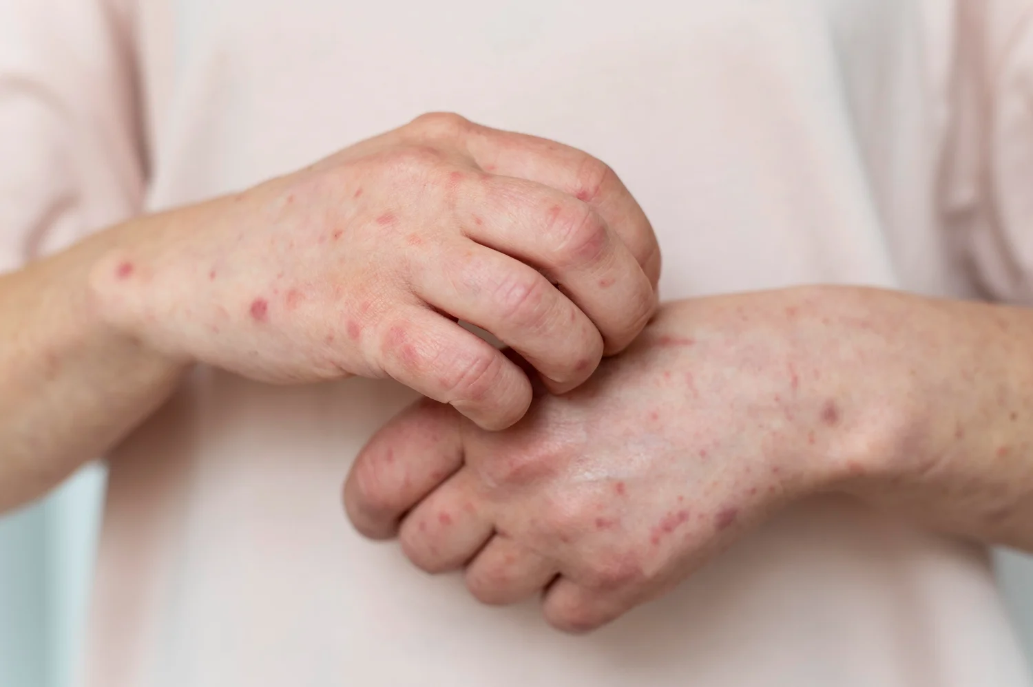 KIZAMIK (MEASLES): AŞIYLA ÖNLENEBİLEN AMA HALA CAN ALAN BİR HASTALIK