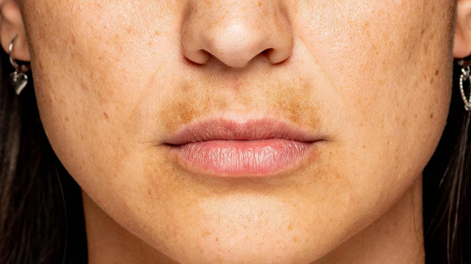 Melasma (Mask of Pregnancy)