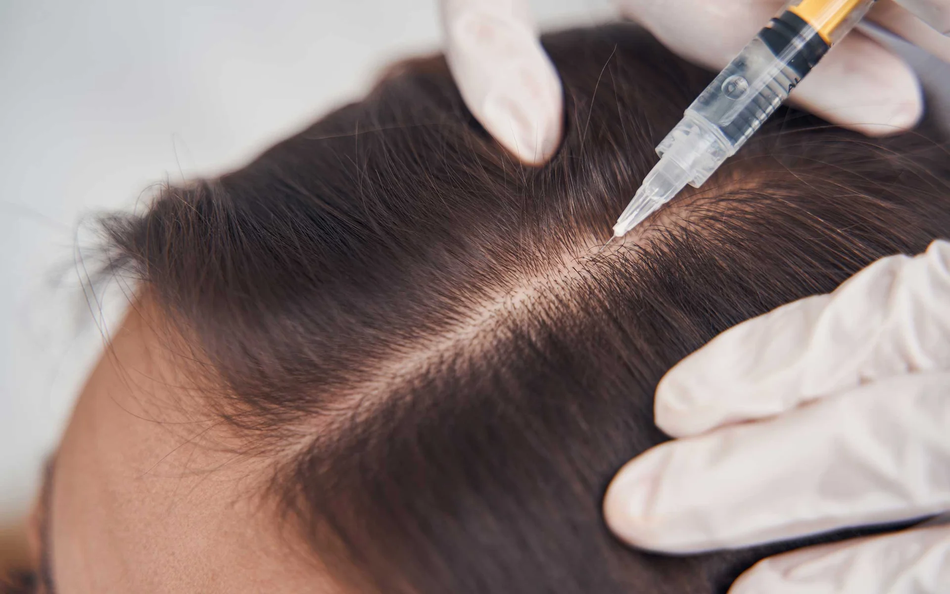 Hair Transplantation