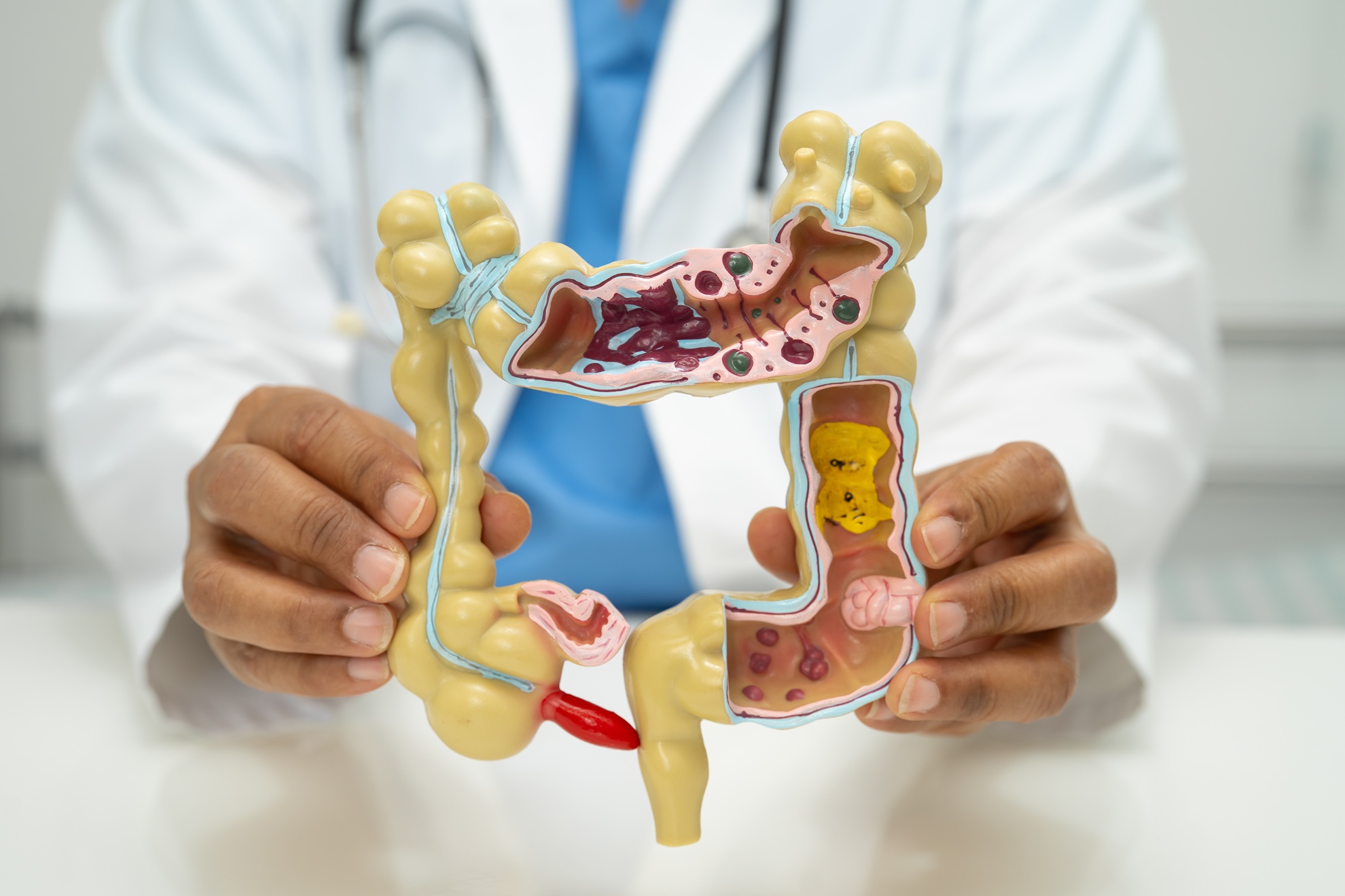 ULCERATIVE COLITIS